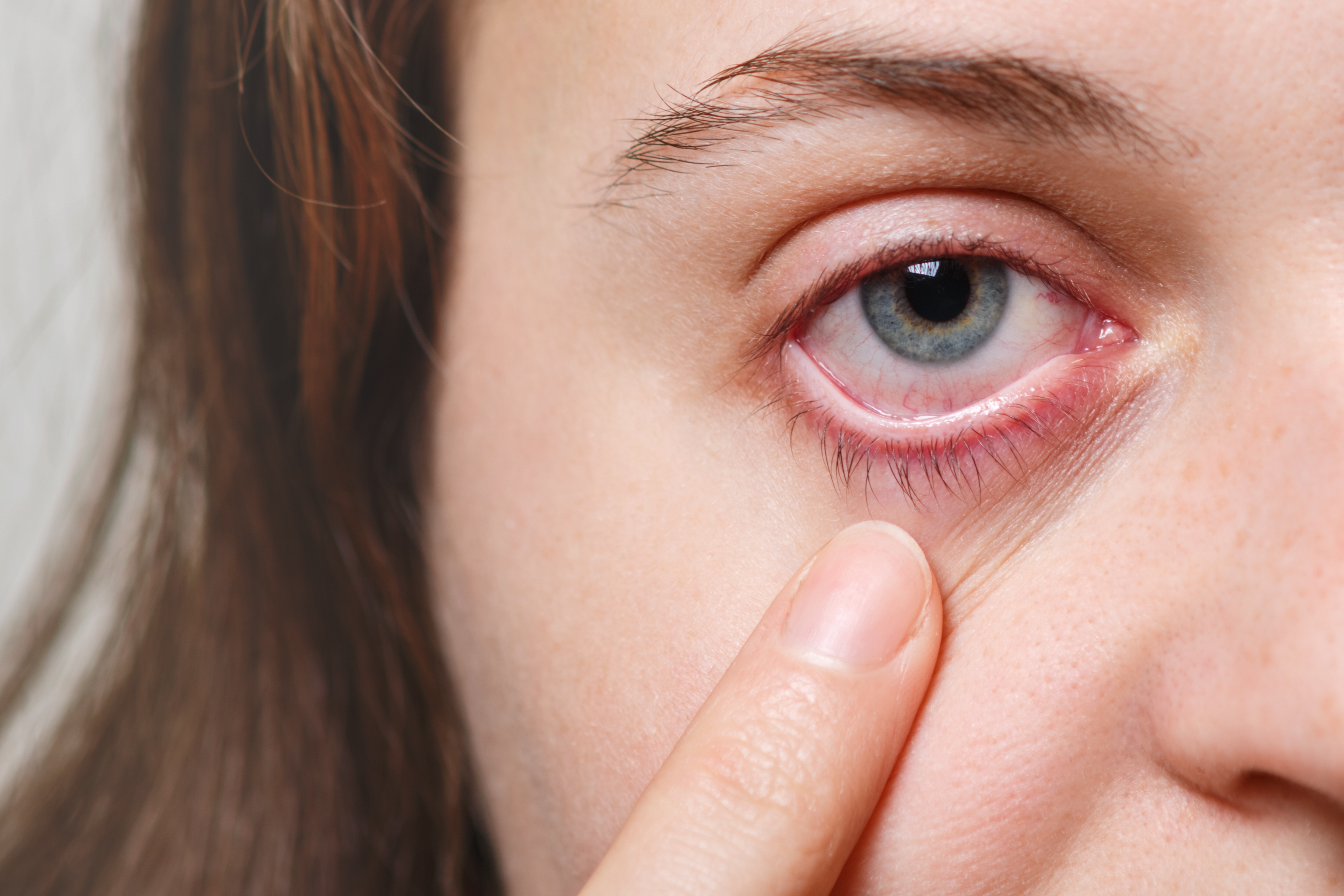 التهاب العيون: أسبابه وأعراضه وعلاجه وطرق الوقاية